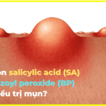 Trị mụn nên dùng acid salicylic hay benzoyl peroxide?