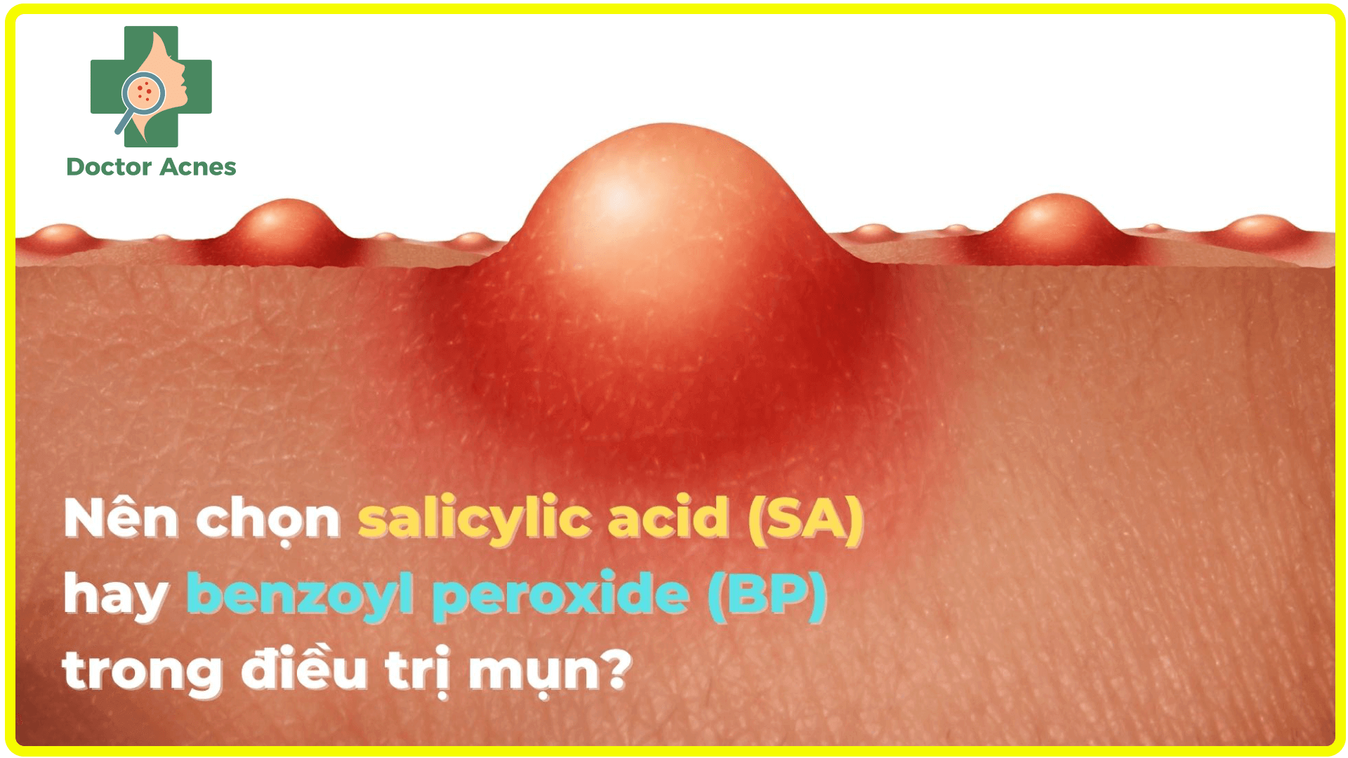 Trị mụn nên dùng acid salicylic hay benzoyl peroxide?