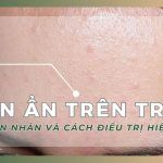 Mụn ẩn trên trán: nguyên nhân và cách điều trị hiệu quả