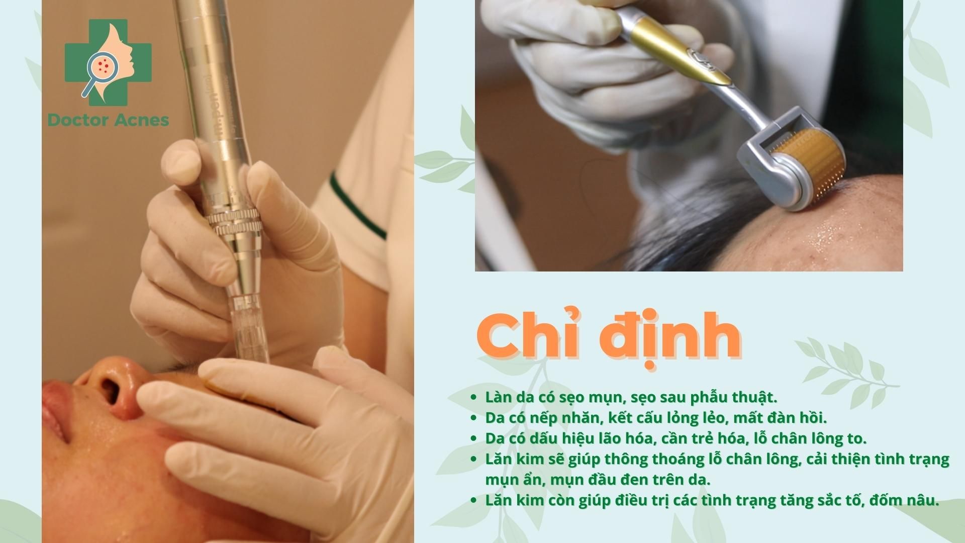 Chỉ định cho liệu trình lăn kim - Doctor Acnes