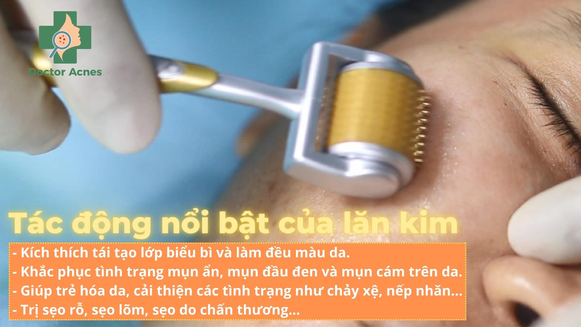 Lăn kim trị sẹo - Doctor Acnes
