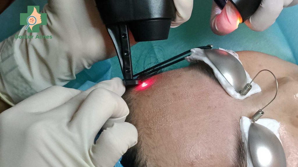 Laser xâm lấn trị sẹo - Doctor Acnes