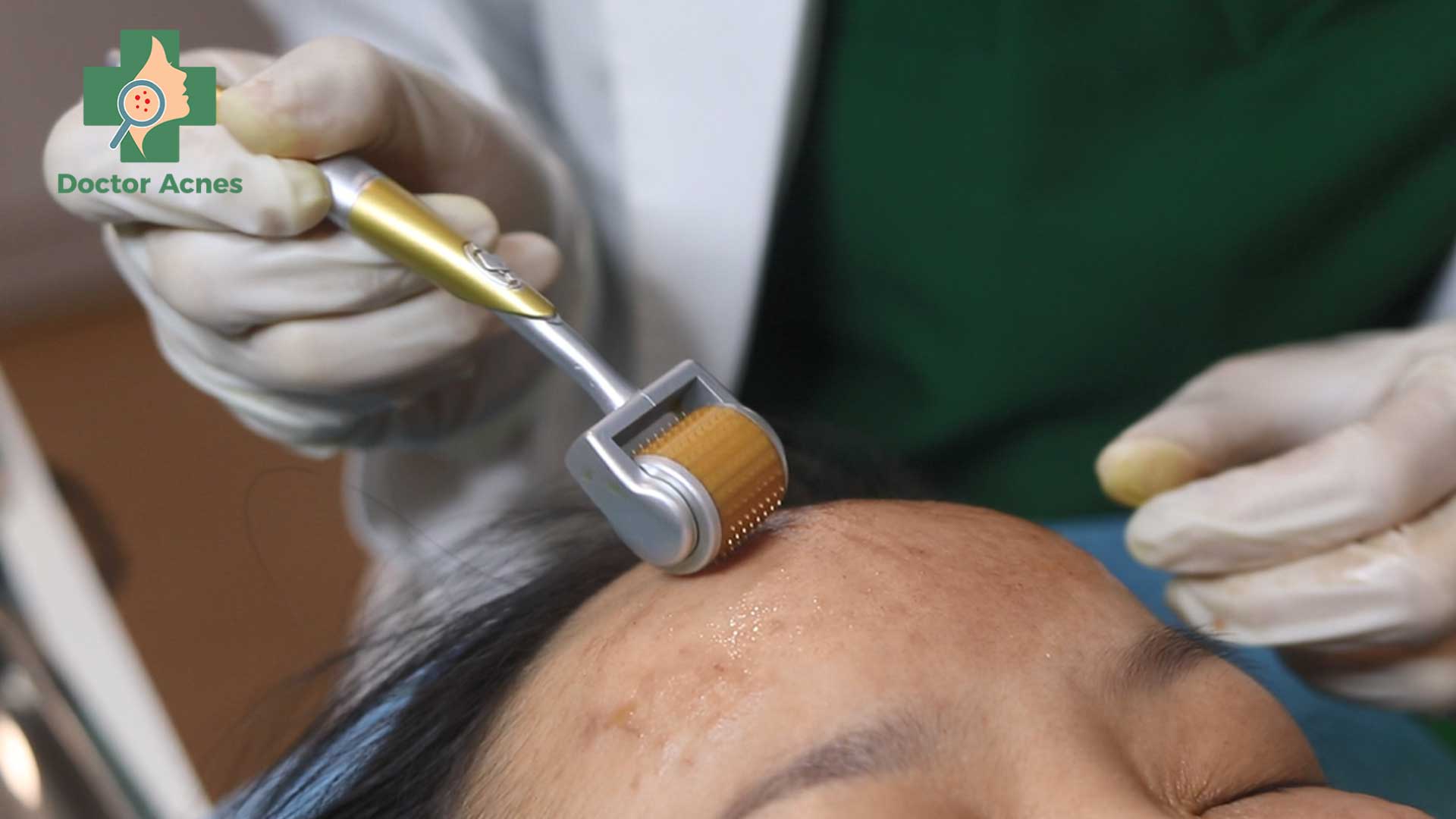 Liệu trình lăn kim thực hiện bởi Bác sĩ Da liễu - Doctor Acnes