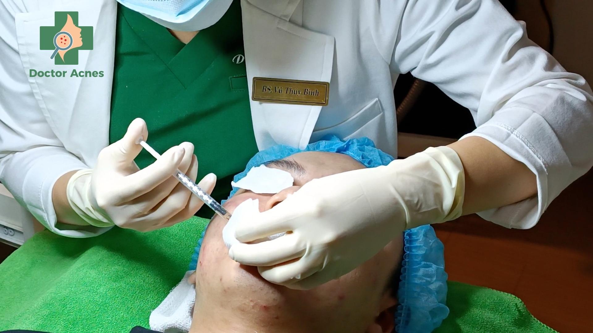 Mesotherapy - Doctor Acnes
