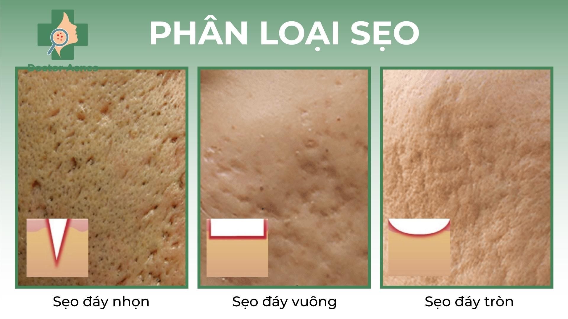 Phân loại sẹo - Doctor Acnes