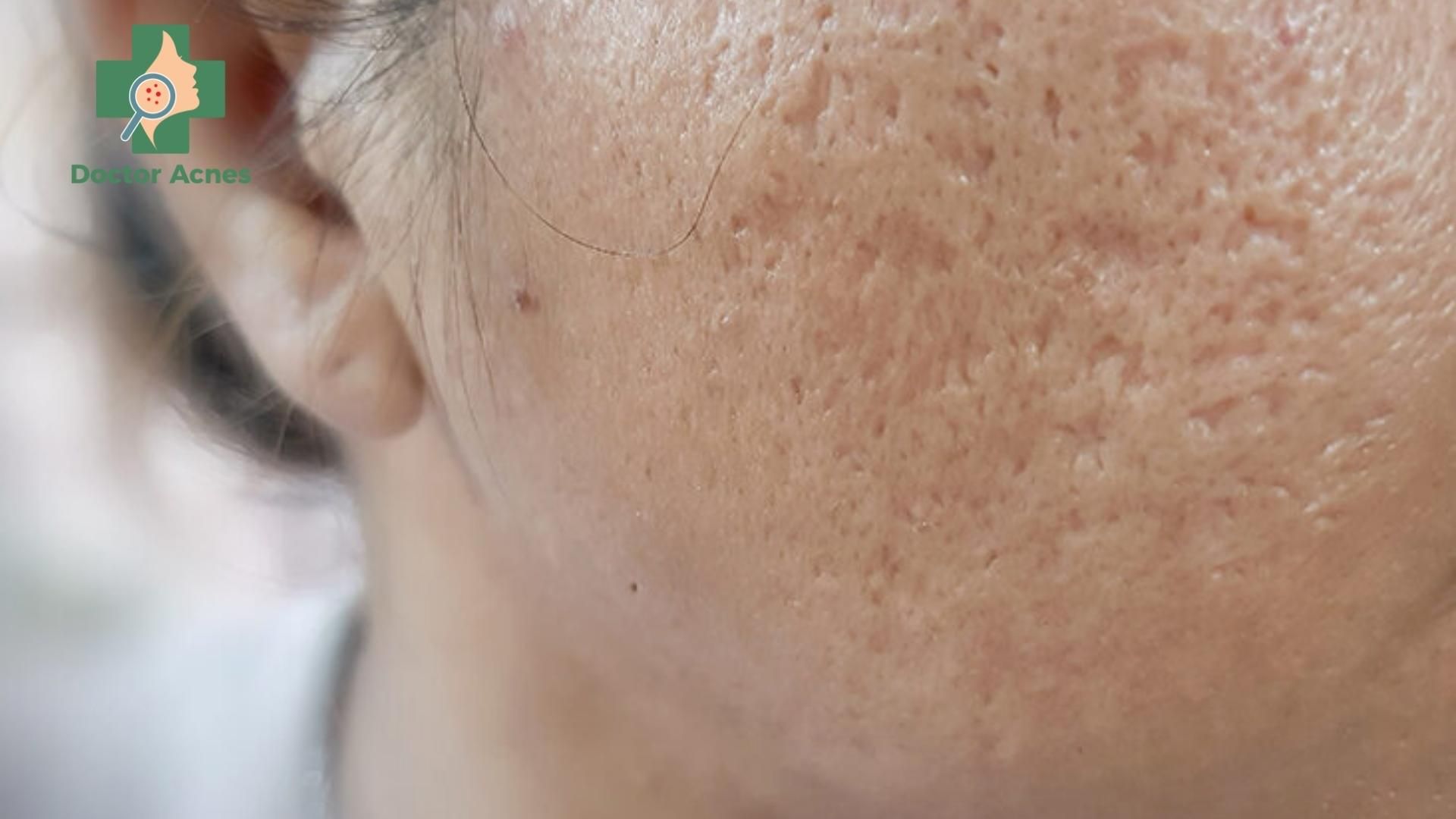 Sẹo rỗ - Doctor Acnes