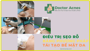 phương pháp tái tạo bề mặt da trị sẹo - Doctor Acnes