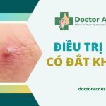 Chi phí điều trị mụn có đắt không?