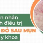 Nguyên nhân và cách điều trị thâm đỏ sau mụn chuẩn y khoa