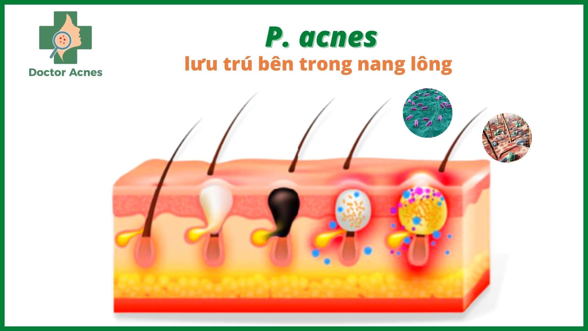 Hoạt động của vi khuẩn P. acnes - Doctor Acnes