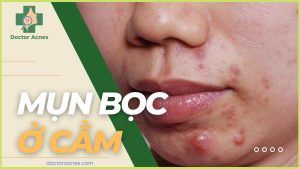 Mụn bọc ở cằm - Doctor Acnes