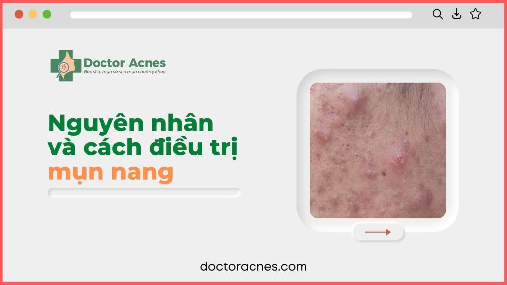 Mụn nang nguyên nhân và cách điều trị, phòng ngừa sẹo rỗ gây bởi mụn nang - Doctor Acnes