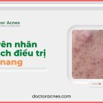Mụn nang: nguyên nhân và cách điều trị, phòng ngừa sẹo rỗ gây bởi mụn nang