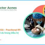 Fractional CO2 và RF microneedle: lựa chọn nào tối ưu trong điều trị sẹo rỗ