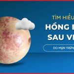 Hồng ban sau viêm do mụn trứng cá và cách điều trị
