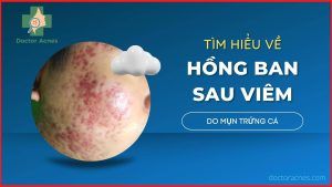 Thumb hồng ban sau viêm - Doctor Acnes