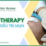 Mesotherapy trong điều trị mụn trứng cá