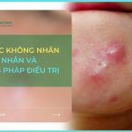 Mụn bọc không nhân: nguyên nhân và cách điều trị