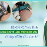 Lăn kim và laser fractional CO2: ưu nhược điểm trong điều trị sẹo rỗ