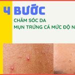 4 bước chăm sóc da mụn trứng cá mức độ nhẹ