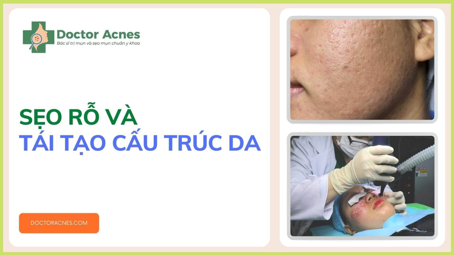 Tiêm meso điều trị sẹo rỗ tại Doctor Acnes