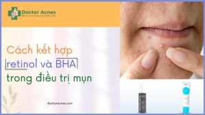 Thumb Cách kết hợp retinol với BHA trong điều trị mụn - Doctor Acnes