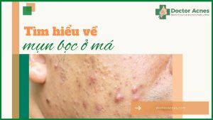 Thumb mụn bọc ở má _ Doctor Acnes