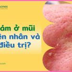 Nguyên nhân, cách điều trị và phòng ngừa mụn cám ở mũi