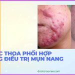 Thuốc trị mụn nang được Bác sĩ Da liễu khuyên dùng