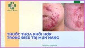 Thumb thuốc thoa phối hợp trong điều trị mụn nang - Doctor Acnes