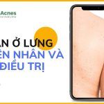 Mụn ẩn ở lưng: nguyên nhân và cách điều trị