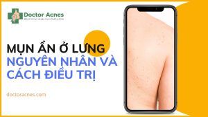 Mụn ẩn ở lưng nguyên nhân và cách điều trị - Doctor Acnes