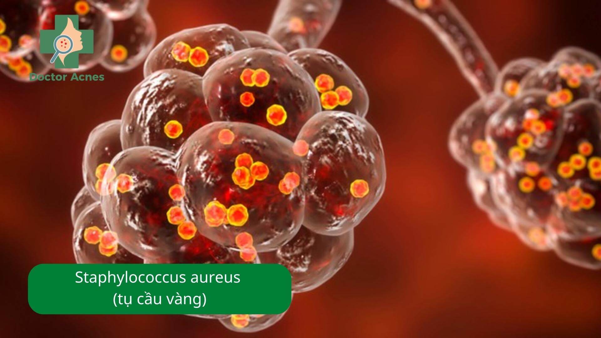Vi khuẩn Staphylococcus aureus (tụ cầu vàng) - Doctor Acnes