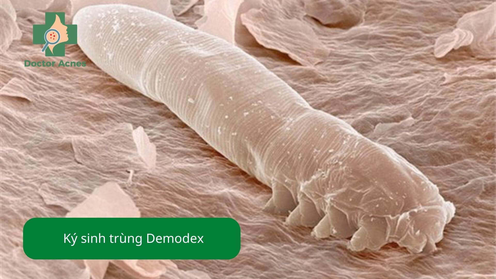 Viêm nang lông do ký sinh trùng Demodex - Doctor Acnes