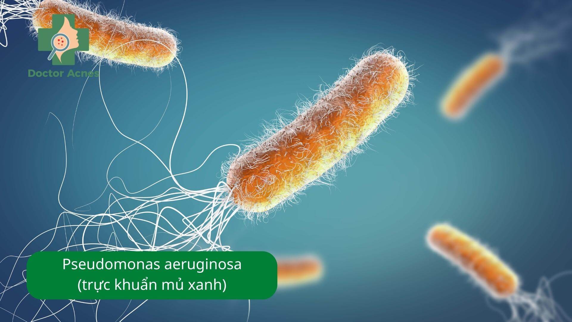 Viêm nang lông do vi khuẩn gram âm Pseudomonas aeruginosa - Doctor Acnes