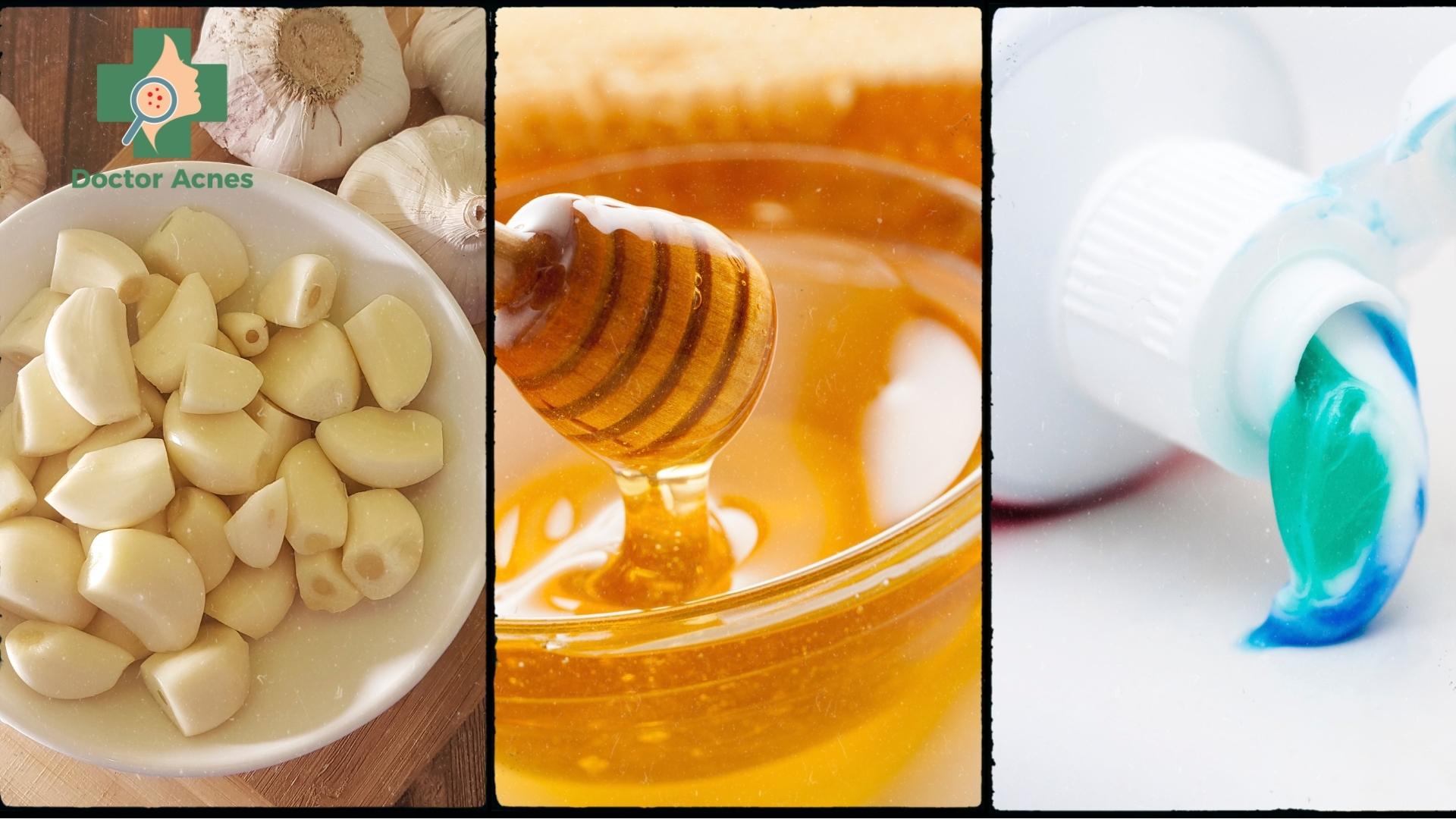 Sử dụng mật ong, tỏi, kem đánh răng trị mụn - Doctor Acnes
