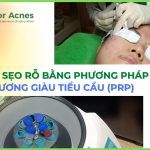 Mesotherapy huyết tương giàu tiểu cầu PRP trong điều trị sẹo rỗ