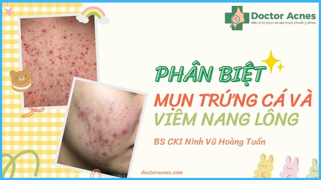 Thumb Phân biệt mụn trứng cá và viêm nang lông - Doctor Acnes