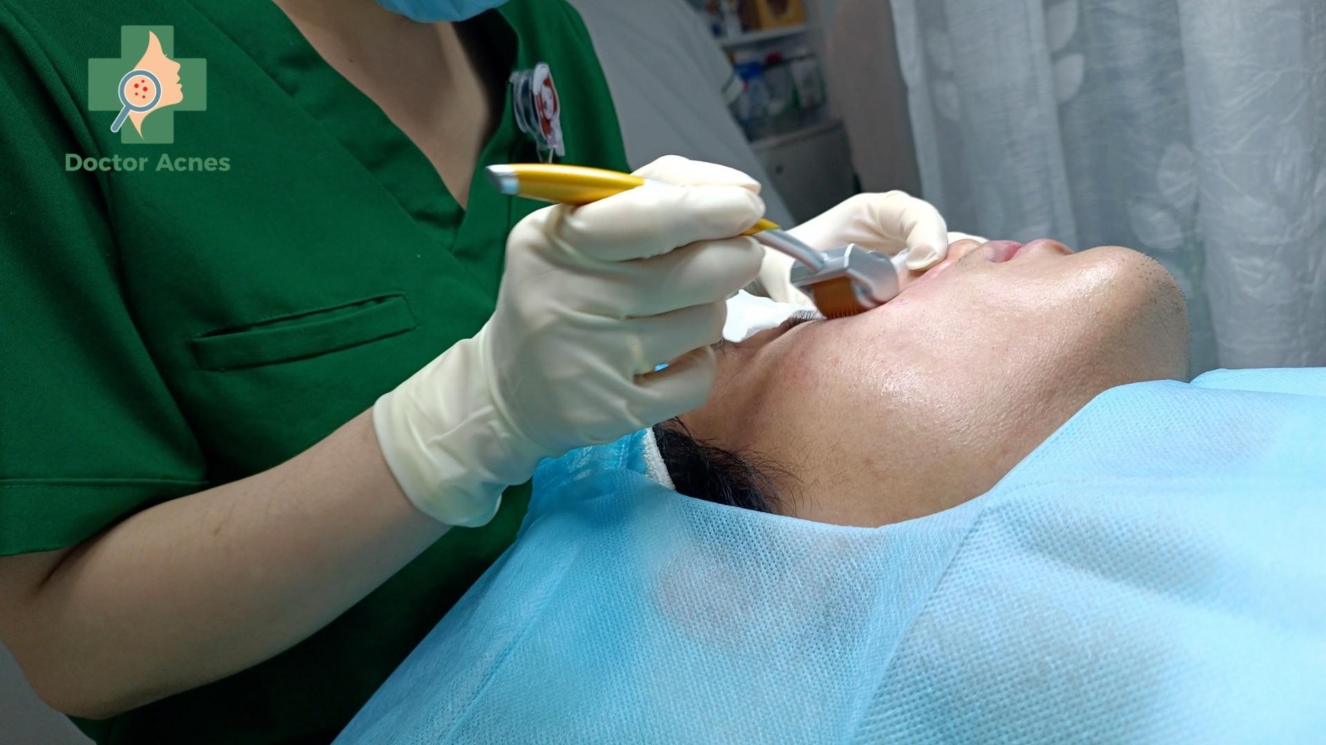 Phương pháp lăn kim điều trị sẹo - Doctor Acnes