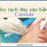 Bóc tách đáy sẹo bằng Cannula: xu hướng mới trong bóc tách đáy sẹo