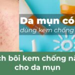 Da mụn có nên dùng kem chống nắng? Cách bôi kem chống nắng cho da mụn