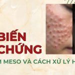 6 biến chứng khi tiêm meso và cách xử lý hiệu quả