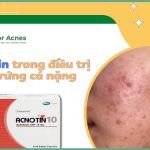 Thuốc trị mụn Acnotin: công dụng trị mụn và cách dùng