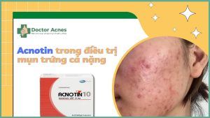 Thumb Acnotin điều trị mụn trứng cá nặng - Doctor Acnes