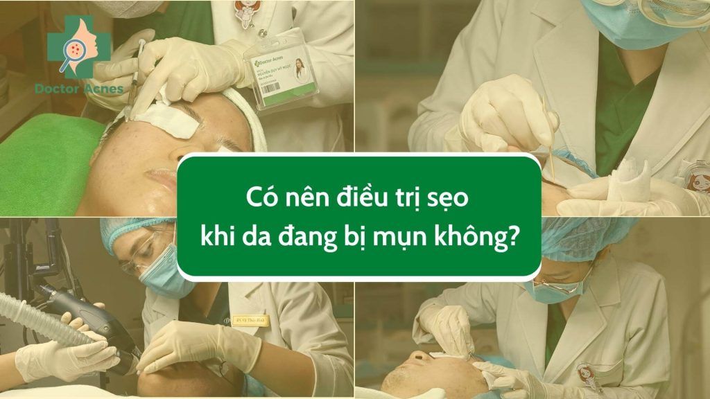 Thumb Có nên điều trị sẹo khi da đang bị mụn - Doctor Acnes