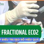 Laser CO2 fractional: 3 tiêu chí tiên quyết đảm bảo hiệu quả tối ưu và an toàn