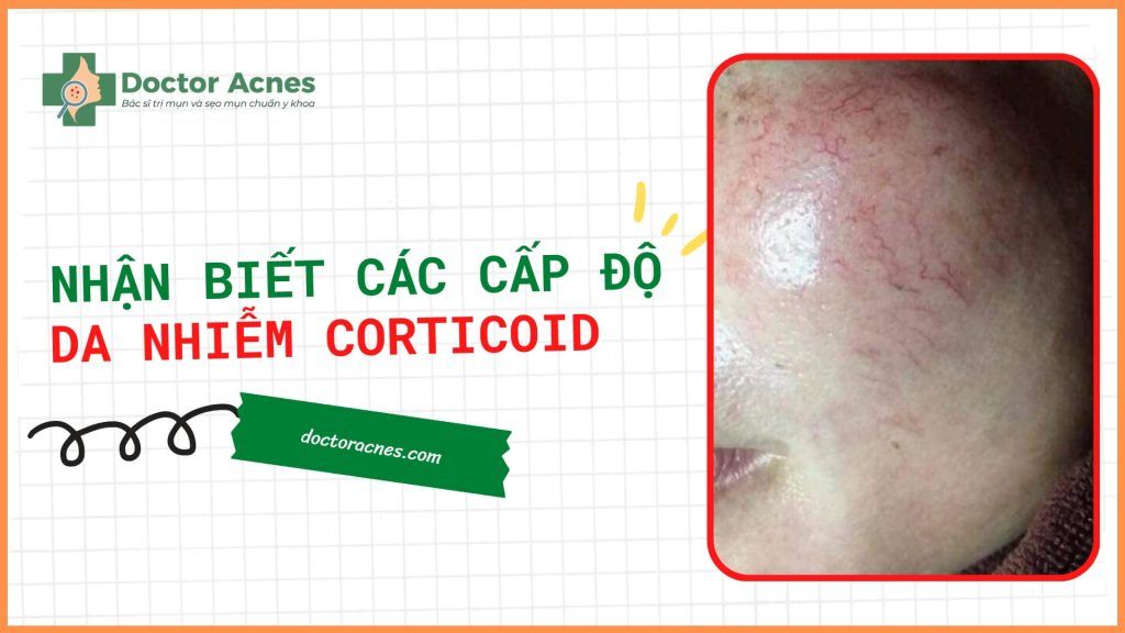 Thumb Nhận biết các cấp độ của da nhiễm corticoid - Doctor Acnes
