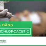 Peel da hóa học bằng TCA (acid trichloroacetic)