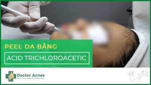 Thumb Peel da hóa học bằng acid trichloroacetic - Doctor Acnes