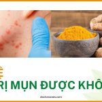 Nghệ có trị mụn được không?